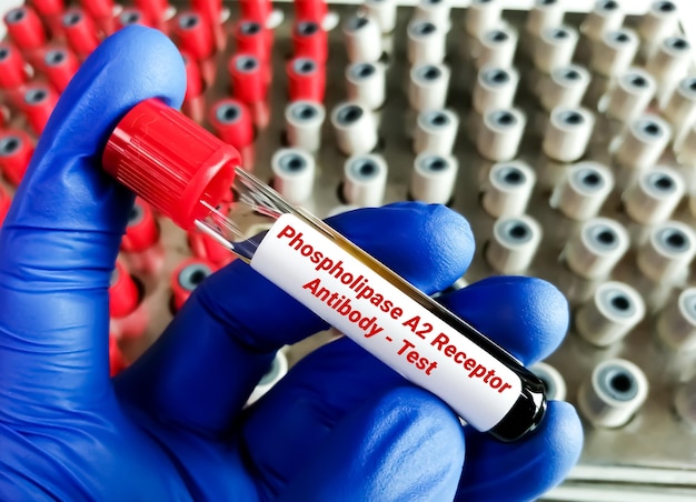 Phospholipase A2 receptor (PLA2R) antibody test for the diagnosis of primary membranous nephropathy.