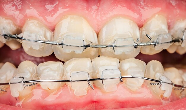 Photo braces closeup .