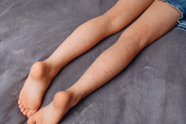 A photo from a close angle of a little girl's legs covered with pigment spots Irregularities of porphyria