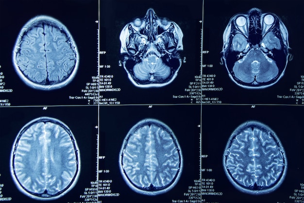 Photo photograph of magnetic resonance imaging of human brain