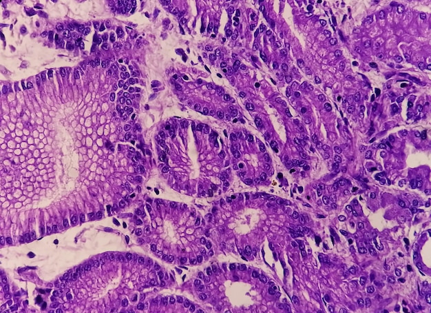 Photomicrograph of Adenocarcinoma of stomach or stomach cancer