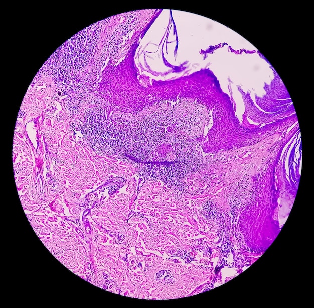 Photo photomicrograph of endometrial carcinoma or cancer for endometrial cancer awareness concept