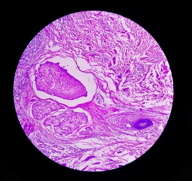 Photo photomicrograph of invasive squamous cell carcinoma of the nipple gradeii