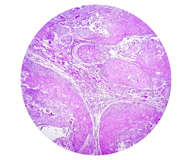 Foto fotomicrografico di carcinoma a cellule squamose invasivo del capezzolo di grado ii