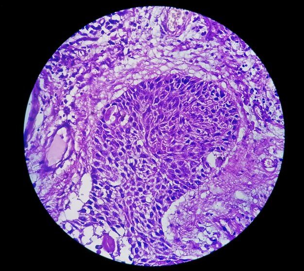 Foto fotomicrografico di carcinoma a cellule squamose invasivo del capezzolo di grado ii