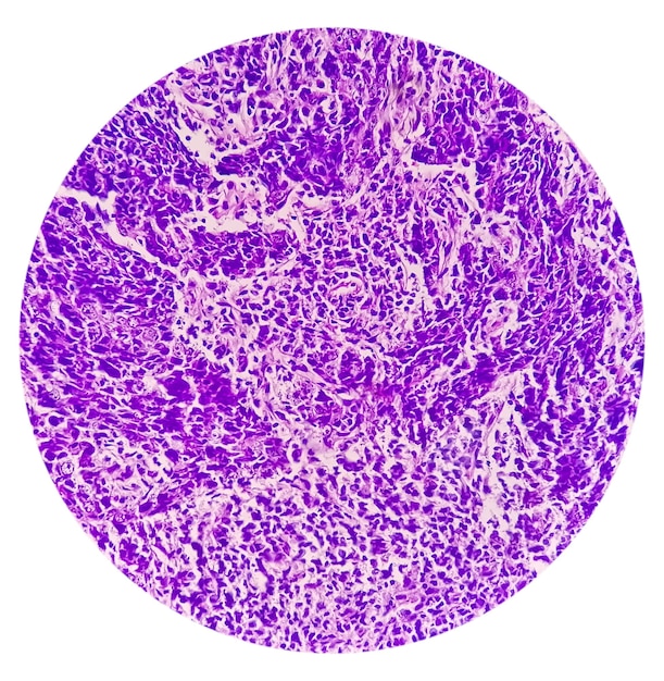 La microfotografia del carcinoma nasofaringeo o del cancro del rinofaringe