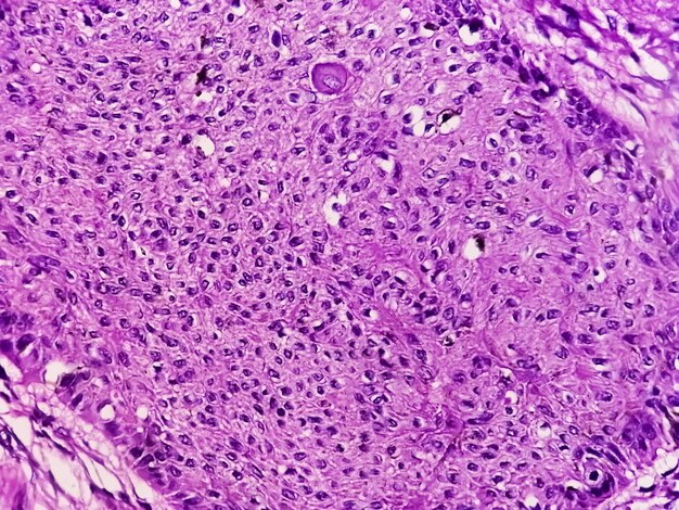 写真 乳首の侵襲性<unk>状細胞がんのフォトマイクログラフ グレードii