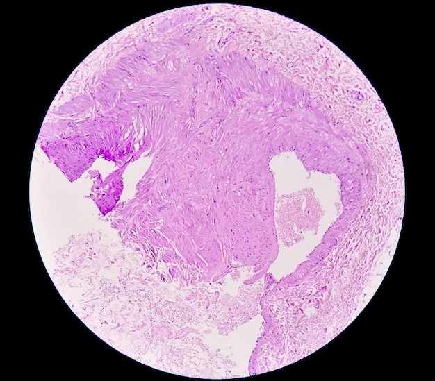 Photomicrograph Prepatellar region histology showing Bursitis acute or chronic Bursitis