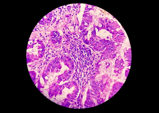 Photomicrograph showing adenocarcinoma a concept of cancer awareness