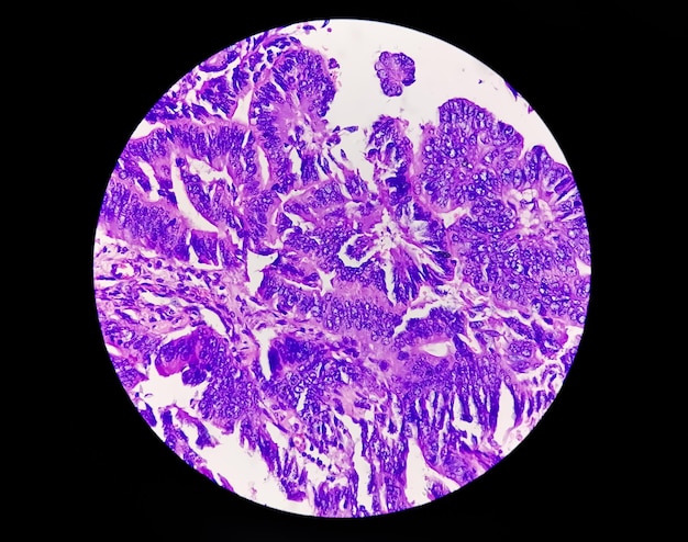 Photo photomicrograph showing adenocarcinoma a concept of cancer awareness