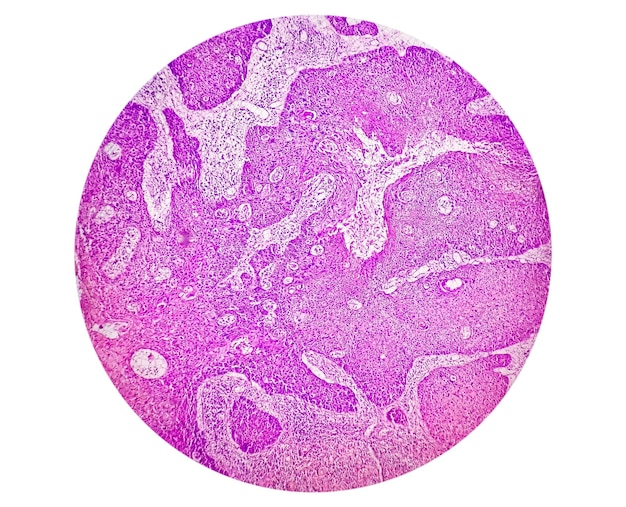 Photomicrograph showing tongue squamous cell carcinoma Grade II. Oral Invasive SCC.