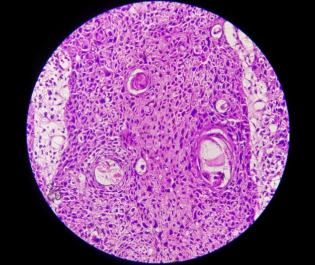 Photomicrograph showing tongue squamous cell carcinoma Grade II. Oral Invasive SCC.