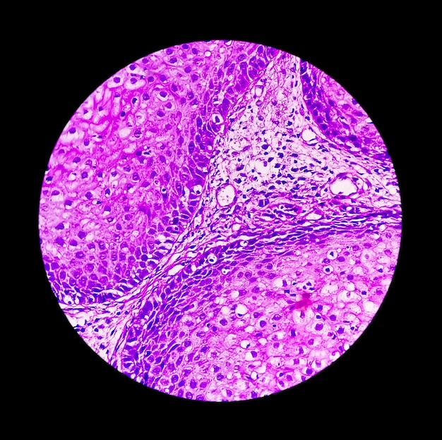 Photomicrograph of an Sino nasal inverted papilloma or SNIP