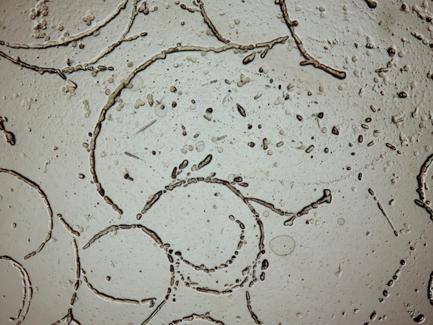 Photomicrograph of skin scraping for fungus test showing dermatophytes.