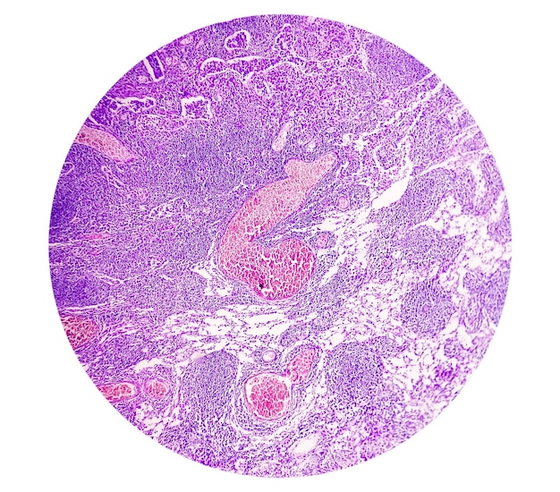 photomicrograph of stomach adenocarcinoma. gastric adenocarcinoma.