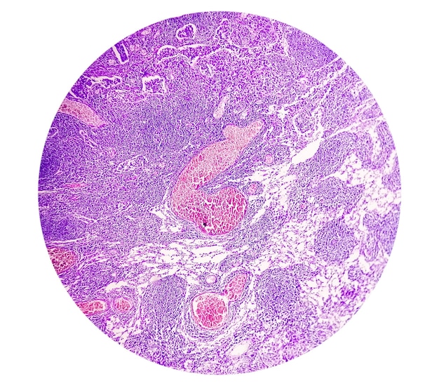 Photomicrograph of Stomach Adenocarcinoma. Gastric Adenocarcinoma.