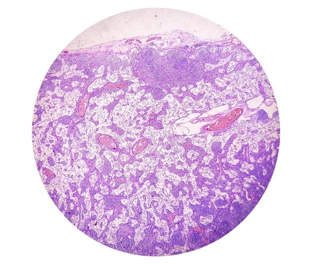 photomicrograph of stomach adenocarcinoma. gastric adenocarcinoma.