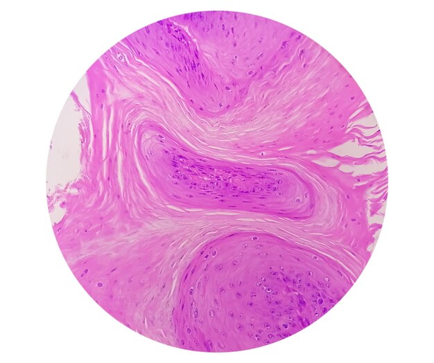 Photo photomicrography of squamous hyperplasia of right lower bucco areola