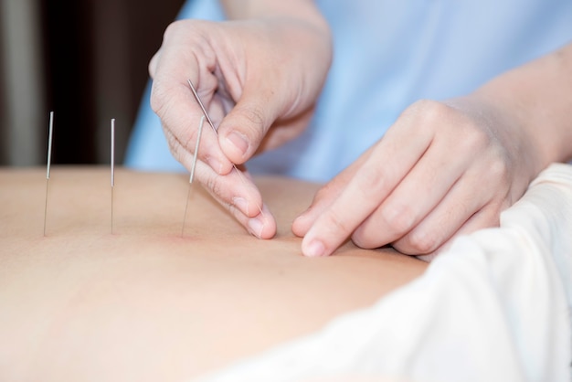 The physiotherapist is doing acupuncture on the back of a female patient