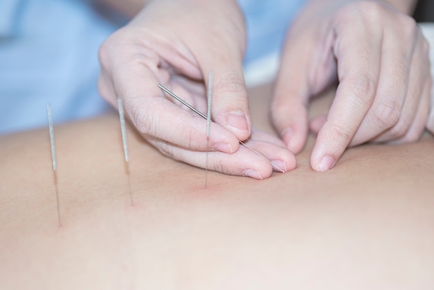 The physiotherapist is doing acupuncture on the back of a female patient