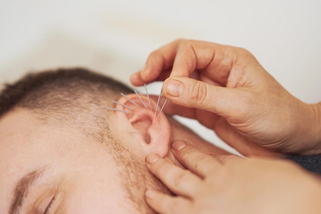 A picture of a man having acupuncture on ear