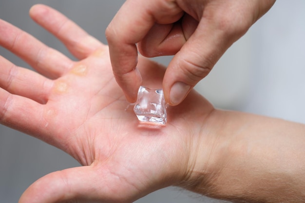 A piece of ice on the palm of a man calluses on his hands