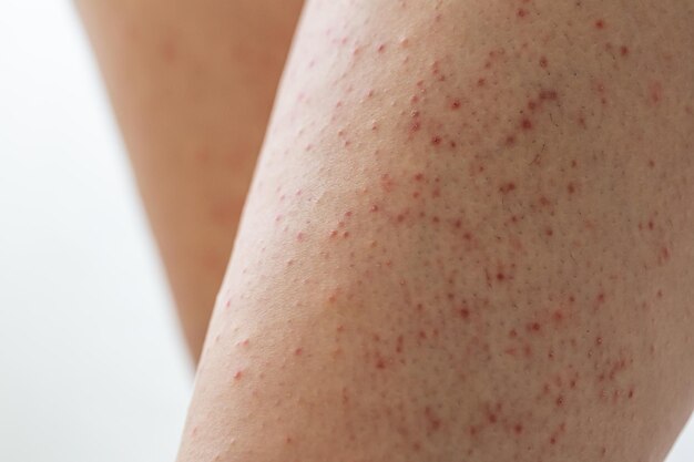 Swollen Blisters On The Skin Caused By Mosquito Bites At Thigh Stock Photo  - Download Image Now - iStock