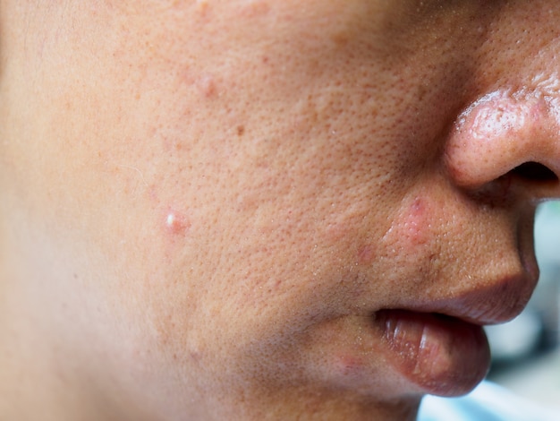 Photo pimple and acne on face skin, zoom macro.