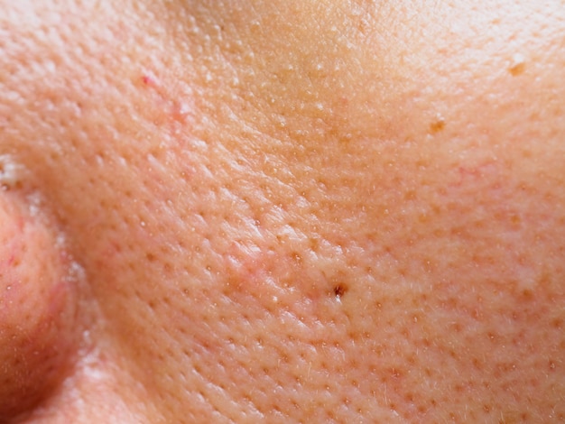 pimple and acne on face skin, zoom macro.