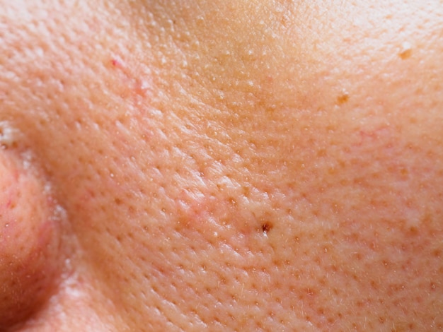 Pimple and acne on face skin, zoom macro.