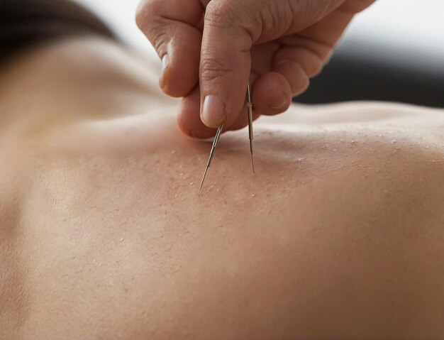 Photo placing acupuncture in a relaxed space