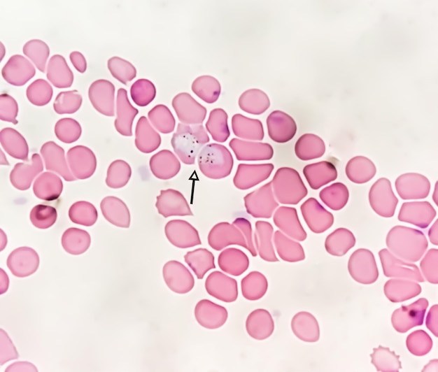 Foto plasmodium vivax in film sottile al microscopio malariopatia p vivax parassita della malaria