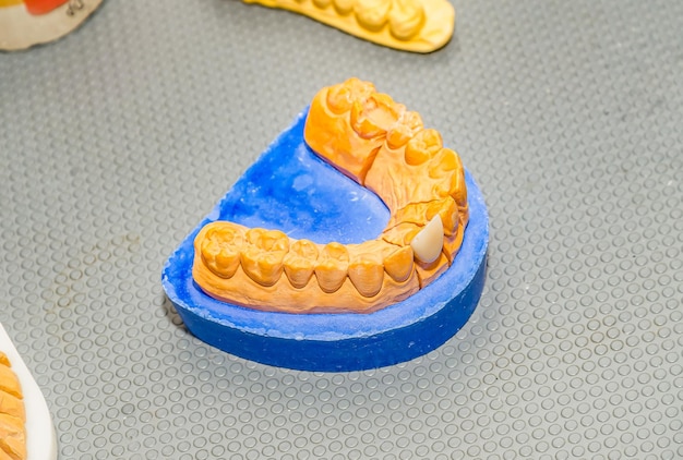 Plaster cast of the jaw in the office of a dental technician