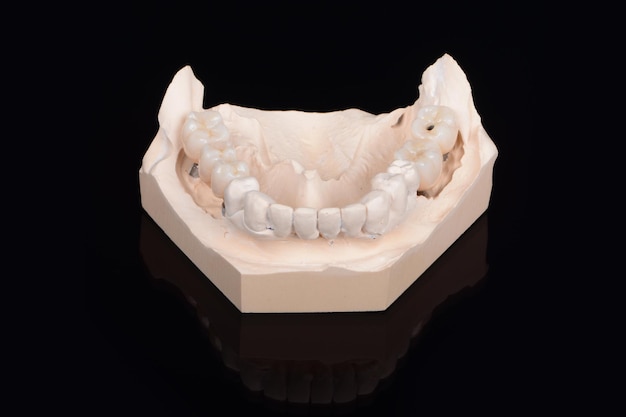 Plaster lower jaw model with zirconia teeth on implants process of manufacturing ceramic teeth on