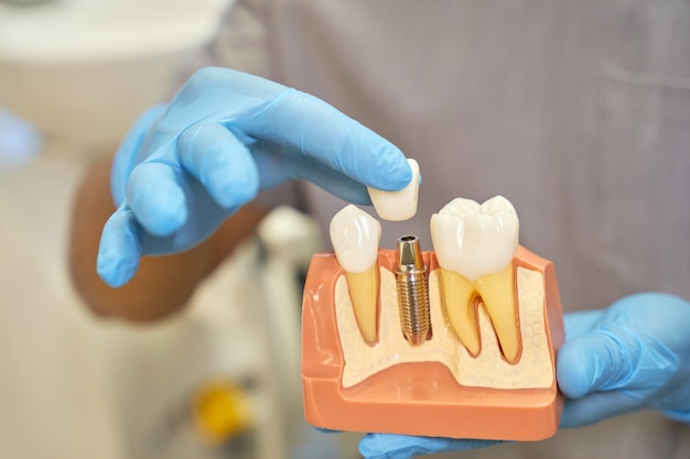 Plastic prop of teeth implant being shown by dentist