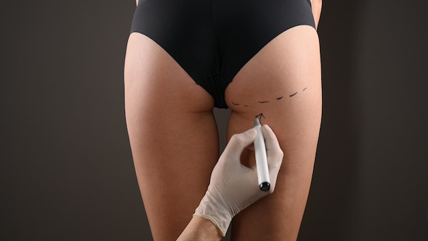 整形外科医が手術のために女性の体に印を付ける