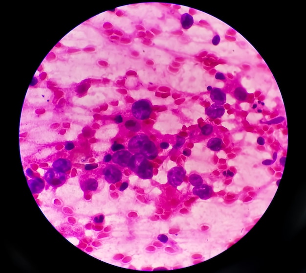 Pleural fluid FNAC showing Photomicrograph of Metastatic adenocarcinoma of lung