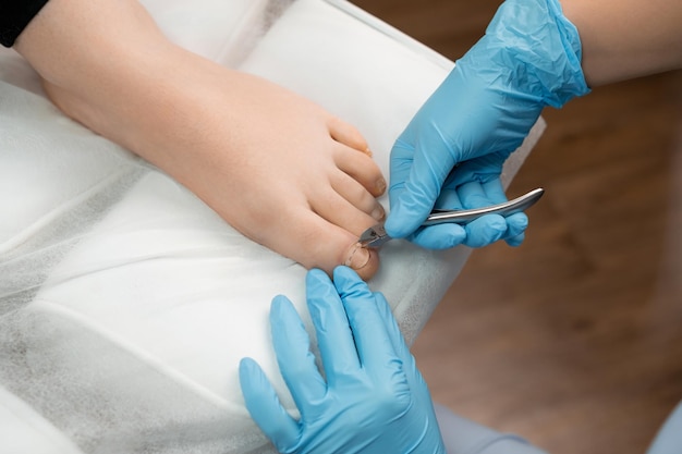 Podologist in blue rubber gloves cuts nails with nippers on female toe in the clinic