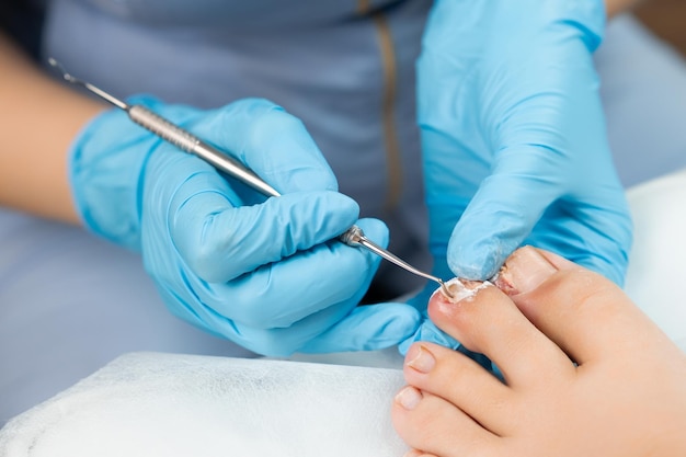 A podologist examines toenails affected by a fungal infection medical pedicure in the clinic