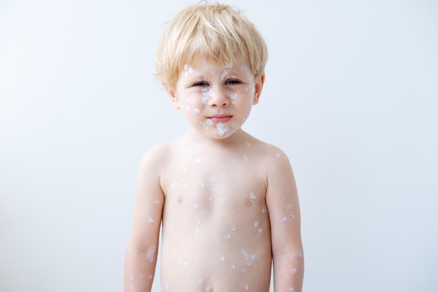 portrait of blonde little boy with red rashes Chicken pox virus, varicella with medical cream