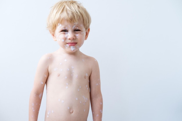 portrait of blonde little boy with red rashes Chicken pox virus, varicella with medical cream