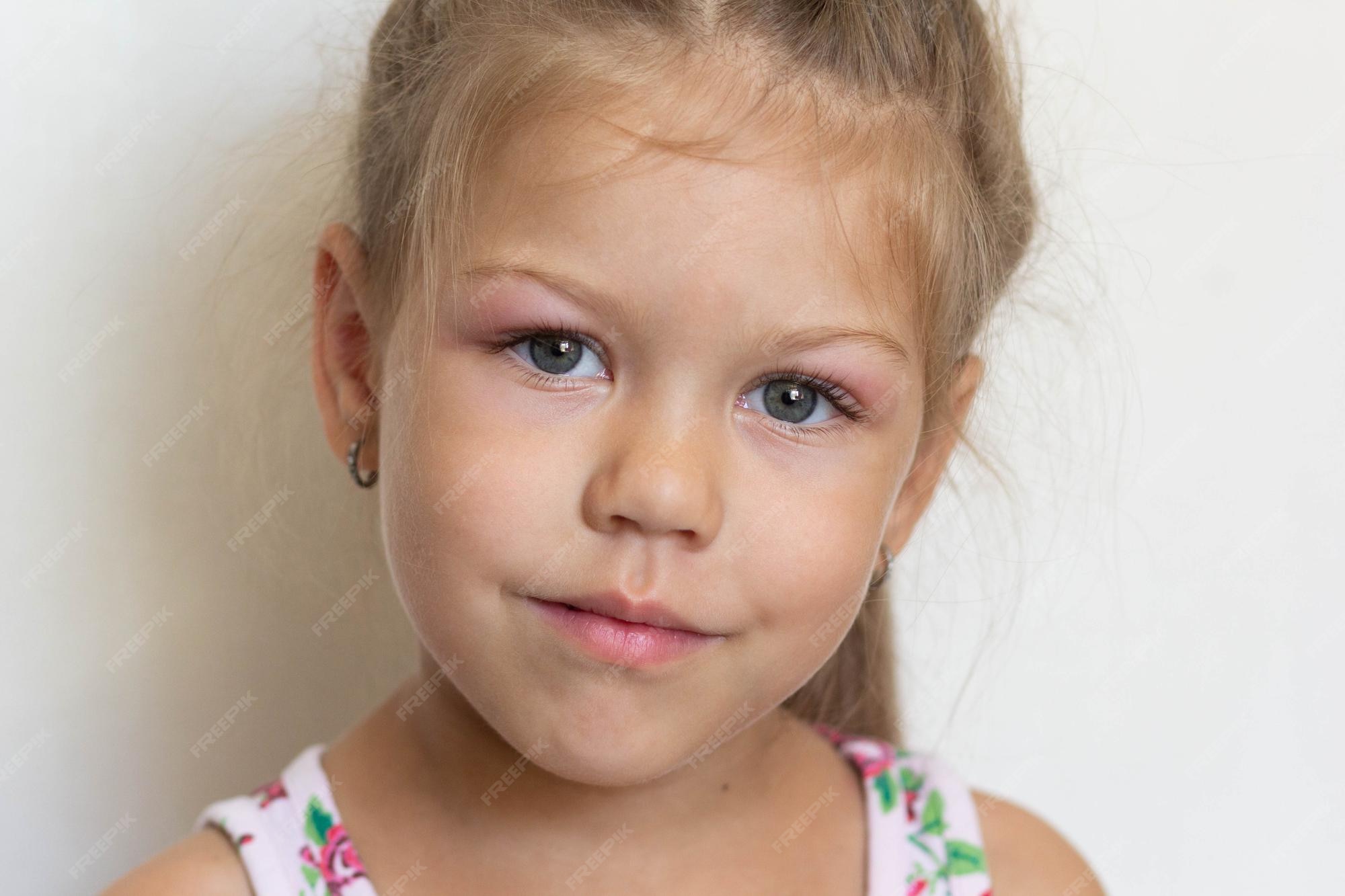 Adenoid Face Before And After
