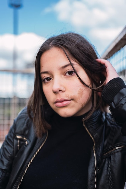 Portrait of a cute teenage girl with a birthmark on her face in an urban park.