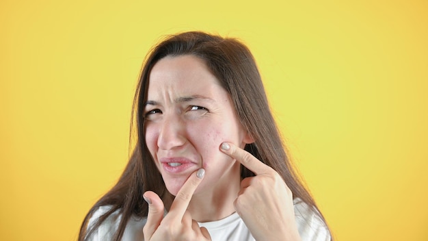 Portrait of disgruntled unhappy brunette Young woman points to acne on her face High quality photo