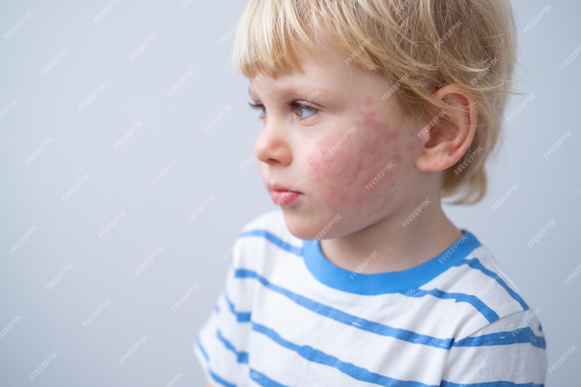 Premium Photo Portrait Of Little Boy With Allergic Rash Or Eczema On