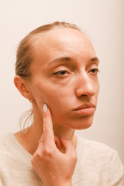 Portrait of an upset young girl without makeup with problem skin points with a finger