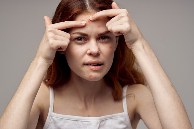 Portrait of a woman squeezes a pimple on her forehead acne\
cosmetology dermatology