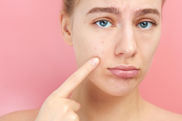 Portret van een jong meisje met een boos gezicht toont vinger op een probleemhuid, acne, zwarte stippen en comedonen close-up geïsoleerd op roze muur