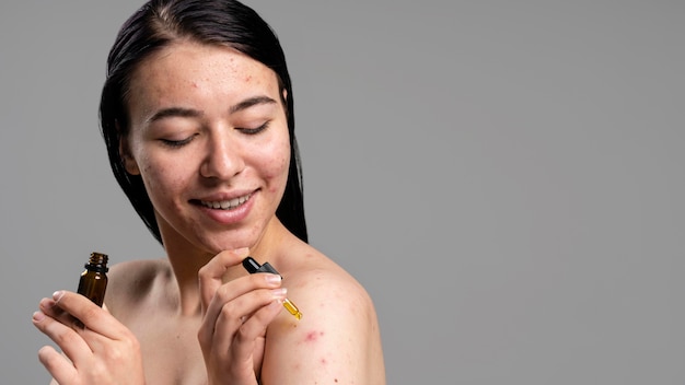 Foto portret van een jonge vrouw met acne