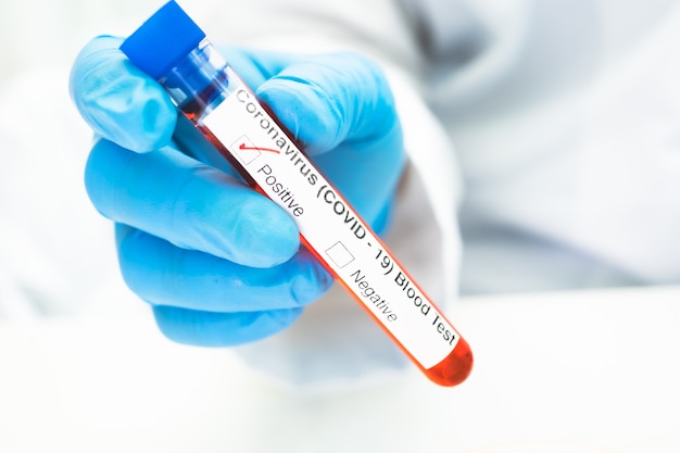 Positive blood infection sample in test tube for covid19 coronavirus in lab